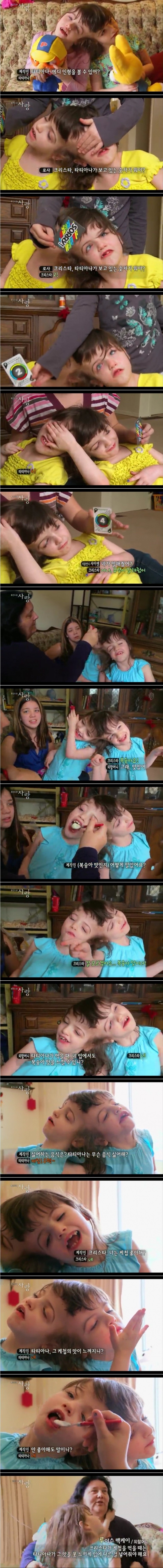 뇌가 연결된 샴 쌍둥이(샴쌍둥이 아이들의 사진있습니다.) | 인스티즈