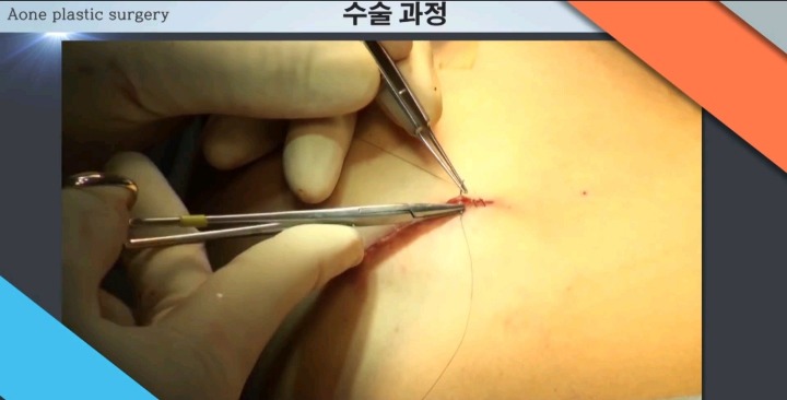 보형물 이용한 가슴성형.jpg (사진주의) | 인스티즈