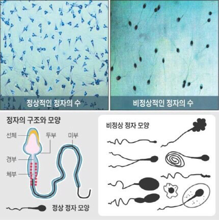hpv 감염 남성이 불임의 원인이며 정자 정상 아니다 | 인스티즈